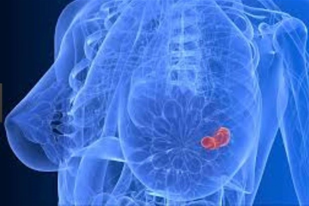 Un estudio revela que la mayoría de las mujeres con cáncer de mama podrían evitar la quimioterapia