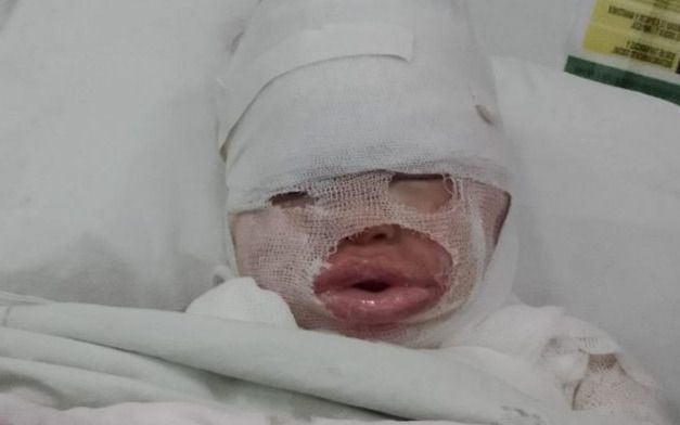 Florencio Varela: una empleada de un restaurante le volcó aceite hirviendo a una nena de 3 años