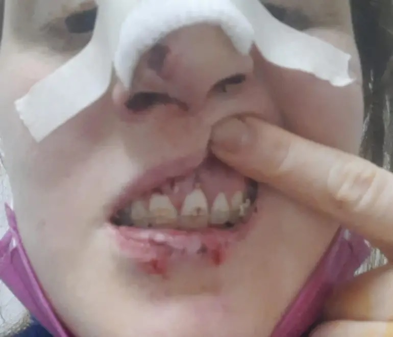 Corrientes: Una mujer sufrió rotura de mandíbula tras un intento de robo