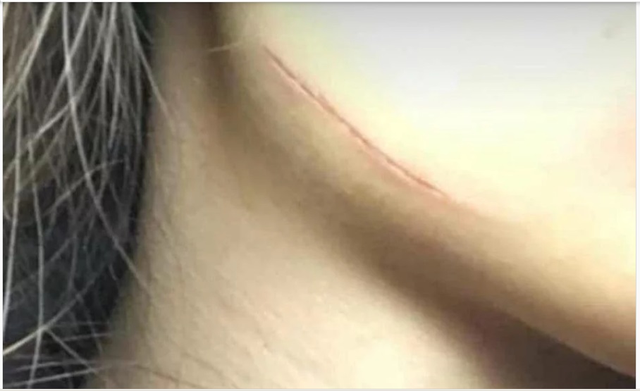 Tolosa: Quisieron secuestrar a una chica de 14 años a la salida del colegio, se resistió y le tajearon la cara