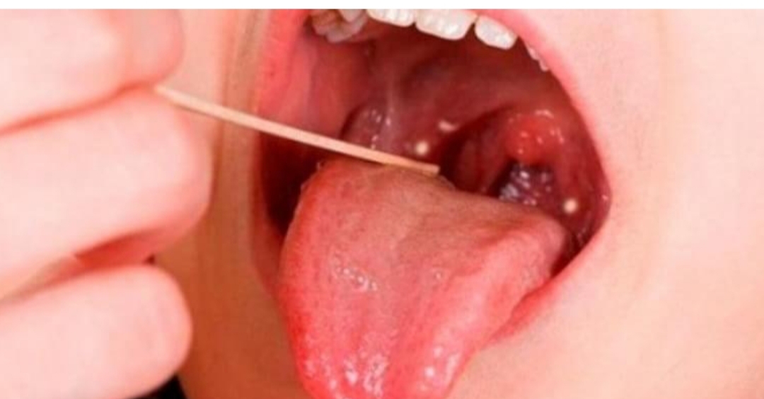 Bacteria estreptococo: cuáles son los síntomas a tener en cuenta