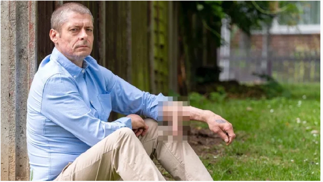 Tuvo su pene en el brazo por 6 años y ahora se lo pusieron en el lugar correcto: “Me siento un hombre de verdad”