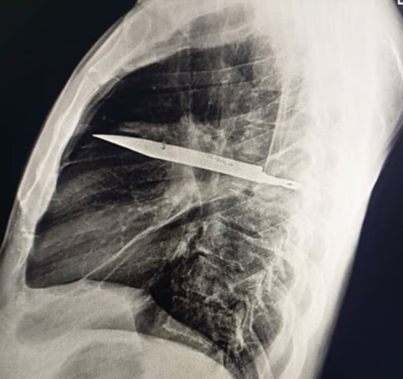 Vivió 8 años sin saber que tenía un cuchillo completo dentro de su pecho