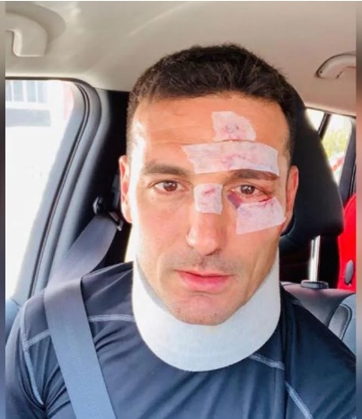 Así quedó la cara de Scaloni tras el accidente